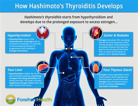 Hashimoto’s Disease & Thyroid Hormone Treatment In Palm。